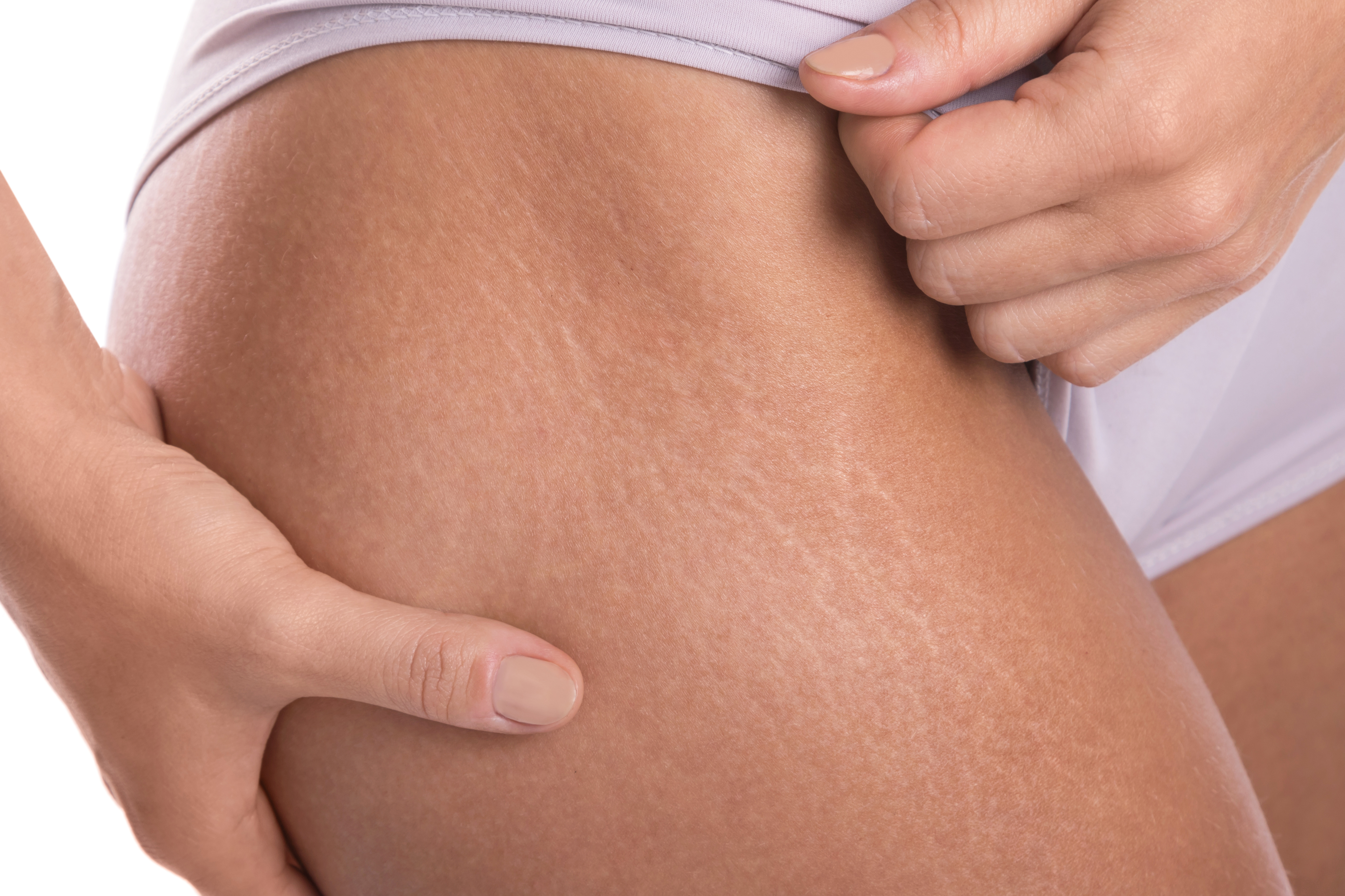 The Causes of Stretch Marks Without Weight Gain