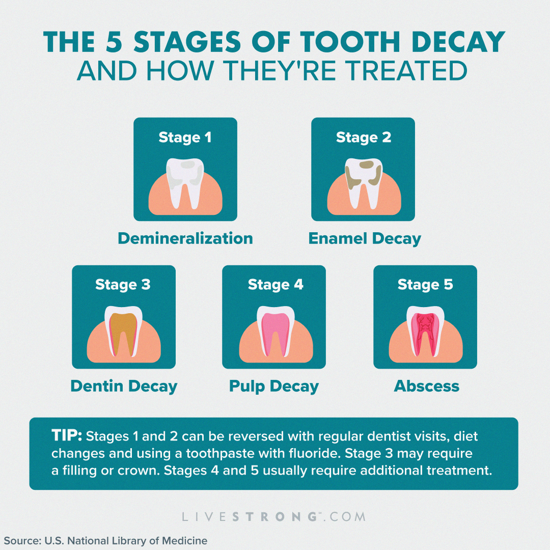 tooth decay stages