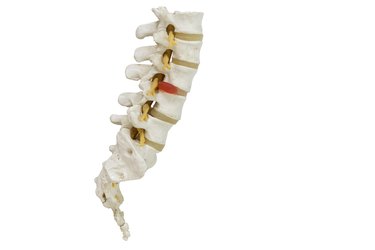 Human lumbar spine model demonstrating herniated disc