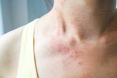 The Symptom of a Rash During a Detox Diet livestrong