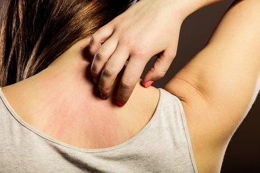 closeup of woman scratching her back after taking vitamin D