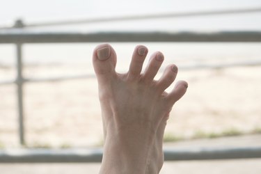 Iron Deficiency and Nail Changes | livestrong
