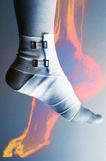 How Long Should You Wait to Exercise a Sprained Ankle?