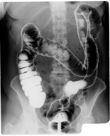 xray of intestines