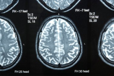 Brain Exercises for Broca's Aphasia | Livestrong.com