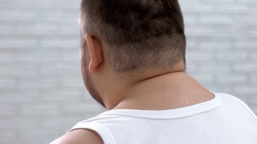 What Are the Causes of Excessive Fat Around the Neck?