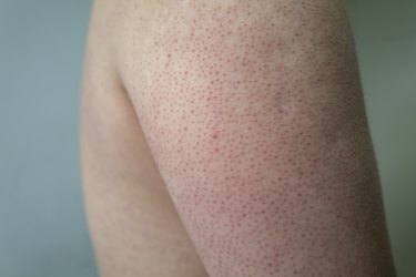 close view of Keratosis pilaris on a person's arm