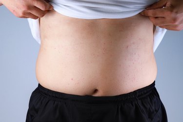 The 9 Best Remedies for Intertrigo, or Rashes Under Fat Folds