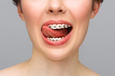 Braces wearers can still enjoy snacks like apples and pretzels, but they should avoid gummy fruit snacks and acidic soda.