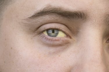 The yellow color of the male eye. Symptom of jaundice, hepatitis or problems with the gall bladder, gastrointestinal tract, liver.