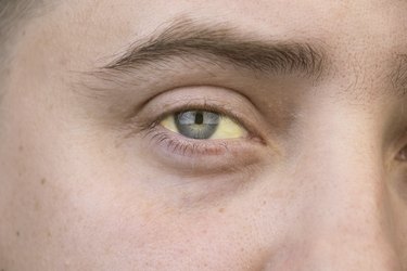 Doctor, doctor: What's causing the yellow streaks in my eyes