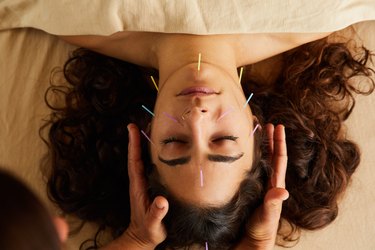 Woman having an acupuncture treatment on her face, as a natural remedy for insomnia