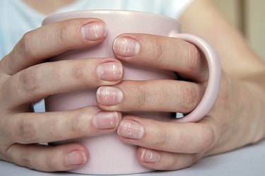 Many white spots on a woman's nails (Leukonychia) due to calcium deficit or stress