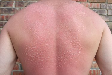 close view of Sunburn Blisters on a person's back