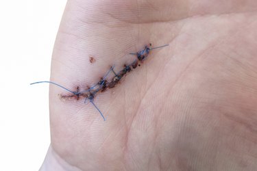 Close Up Of A Sutured Wound