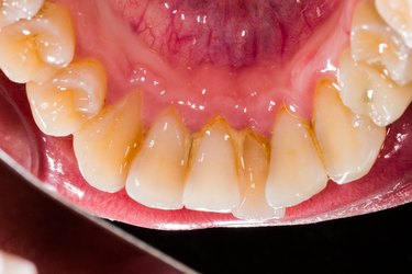close view of calcium deposits on teeth