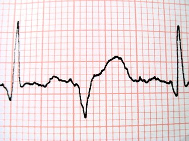 A Heart Rate During a Heart Attack | livestrong