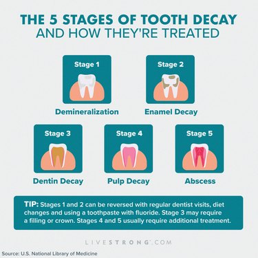 Infograph of the five stages of tooth decay and how they're treated