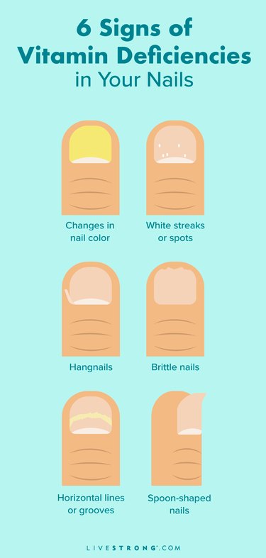 an infographic of the types of nail changes that can happen from vitamin deficiencies.