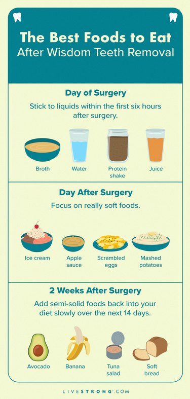 vertical rectangular infographic displaying the best foods to eat after wisdom teeth removal and when to eat them, including liquids on the day of surgery, very soft foods the day after, and reintroducing semi-solid foods in the following 2 weeks, with illustrations of these different types of foods