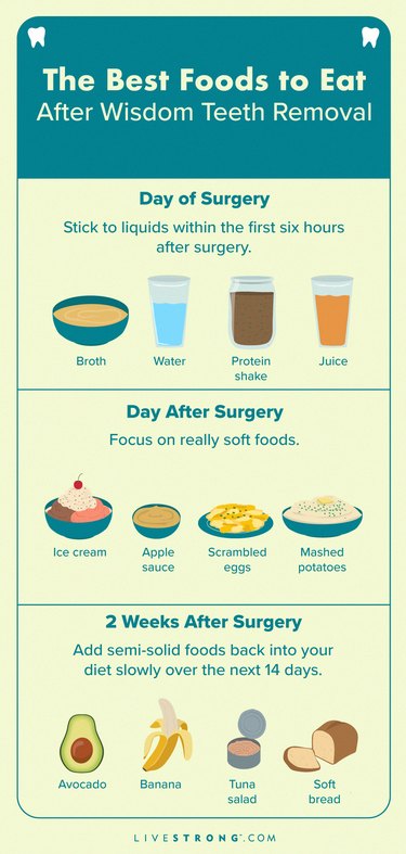 The Best Foods To Eat After Wisdom Teeth Removal Livestrong