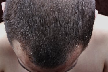 dry flaky scalp