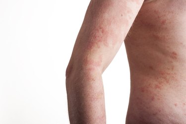 Psoriasis on the body