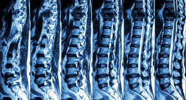 fracture of thoracic spine and compress spinal cord