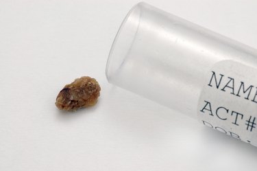 Kidney Stone