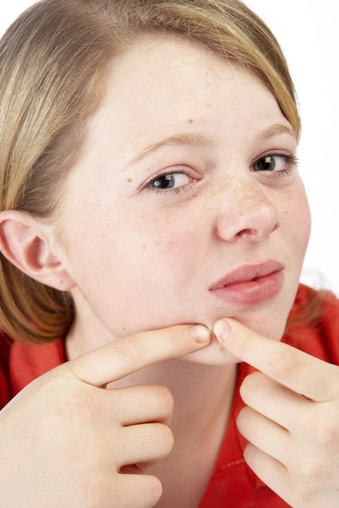 Teenage girl picking at acne