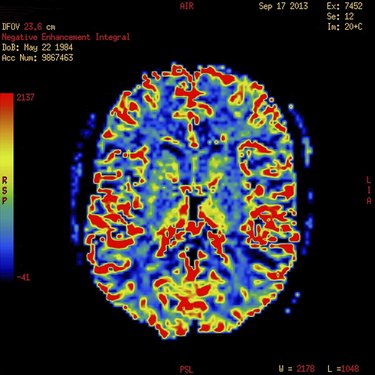 Perfusion MR imaging of a normal brain