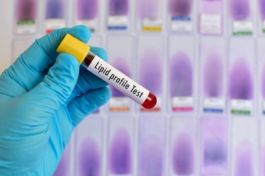 Blood sample for lipid profile test