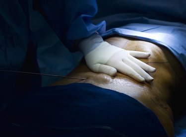 Five Things You Need to Know About Stomach Liposuction