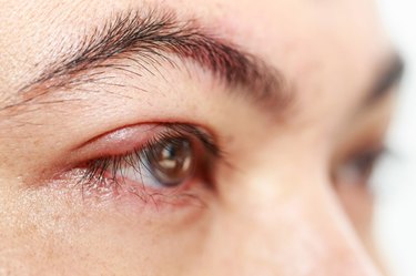 Right upper eye lid abscess "stye or hordeolum"
