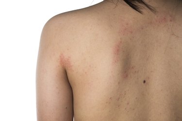 eczema skin of human back detail texture