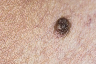 Mole on human skin