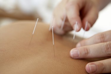 Therapist performing acupuncture