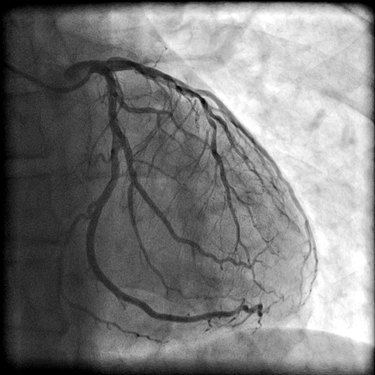 Coronary artery