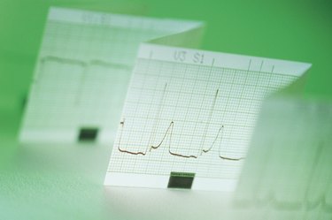 Printout of electrocardiogram