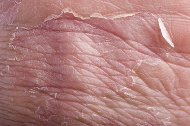eczema closeup