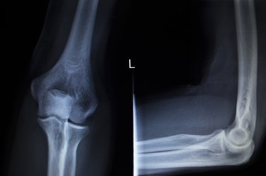 X-ray orthopedics Traumatology scan of elbow joint injury