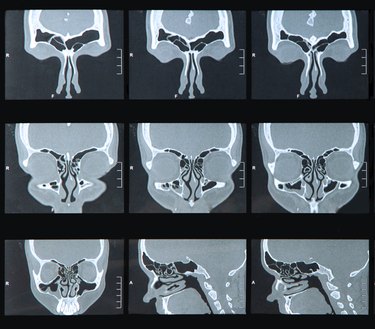 Sinus MRI