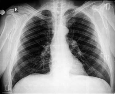 Chest X-ray image