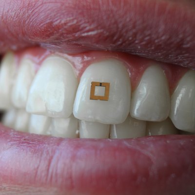 closeup of mouth and teeth with tooth fitbit