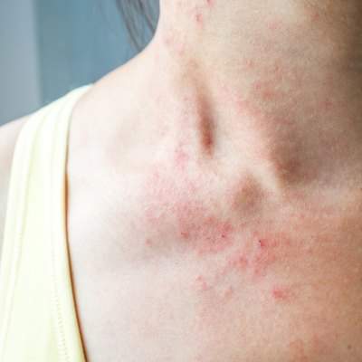 Young woman has skin rash itch on neck