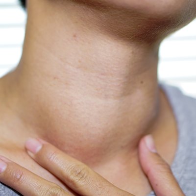 Asian lady woman patient have abnormal enlargement of thyroid gland Hyperthyroidism (overactive thyroid) at the throat : healthy strong medical concept