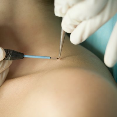 Wart removing