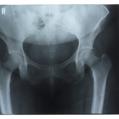 X-ray of hips