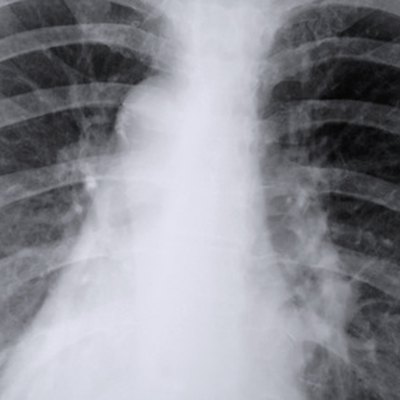 A wheezing cough, phlegm, a respiratory infection