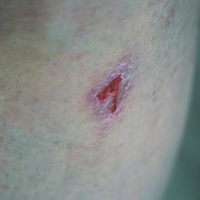 Hydrogen peroxide, bacterial infections